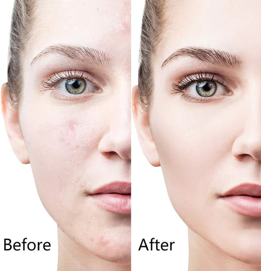 6-in-1 Derma Roller System